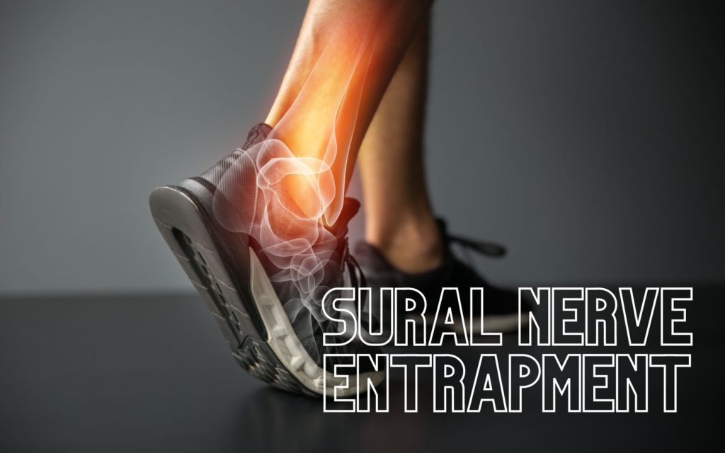 sural nerve entrapment