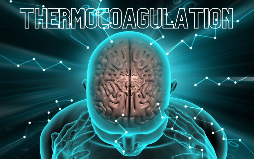 Thermocoagulation