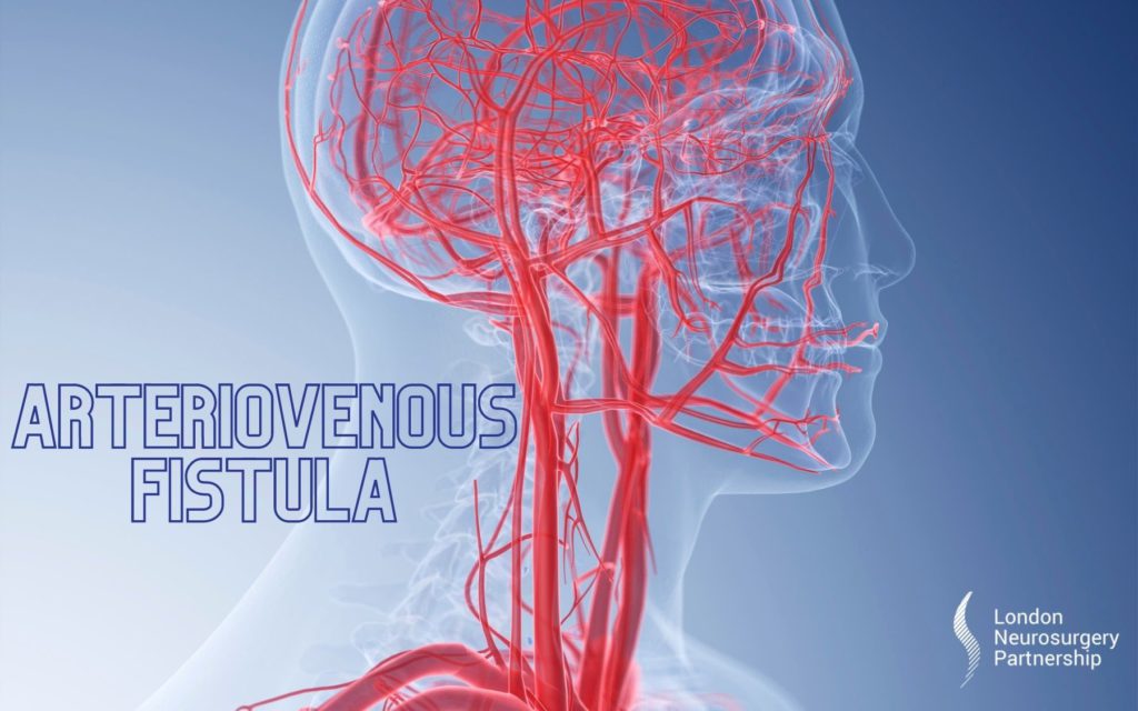 arteriovenous fistula