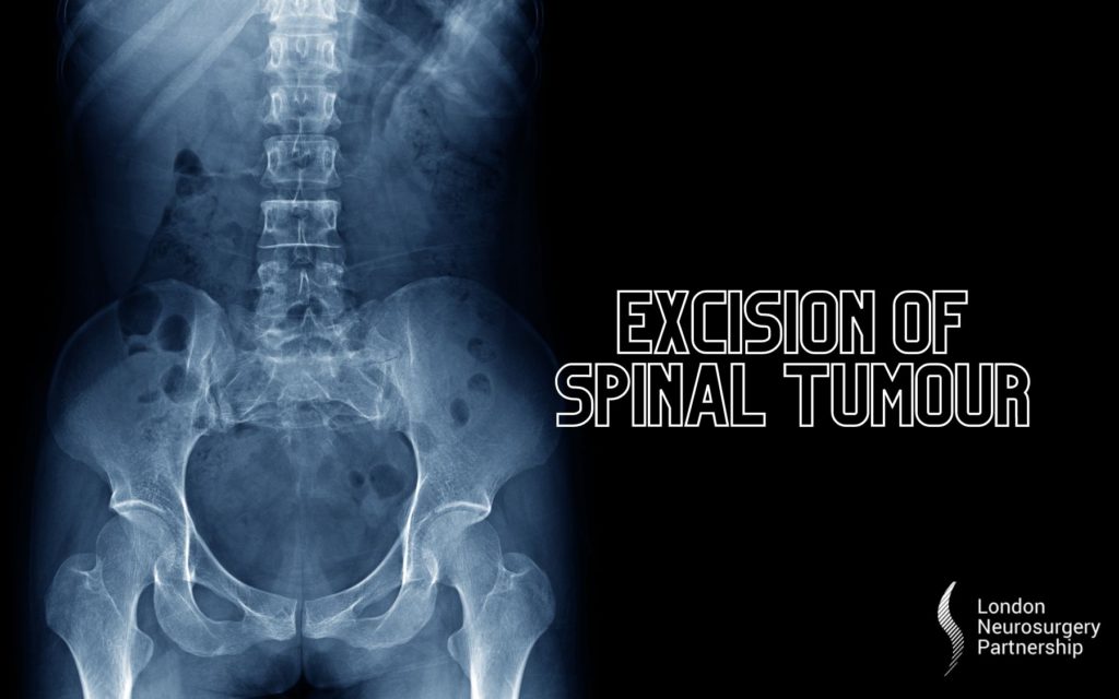 Excision of spinal tumour