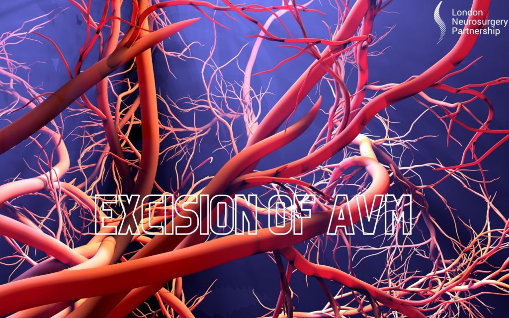 excision of avm